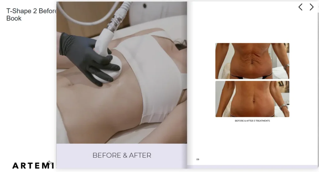 Before and after photos of a body contouring treatment on the abdomen.