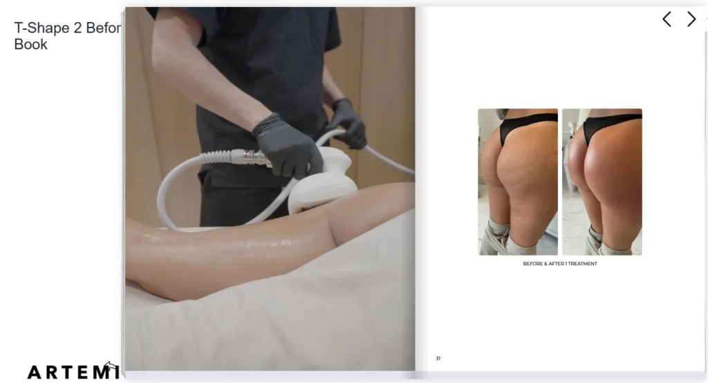 Professional cellulite treatment using a handheld device on a patient's thigh.